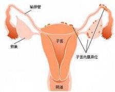 微創(chuàng)聯(lián)合用藥兩期療 微創(chuàng)治療子宮內(nèi)膜異位癥
