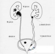尿道結(jié)石疼痛怎么辦