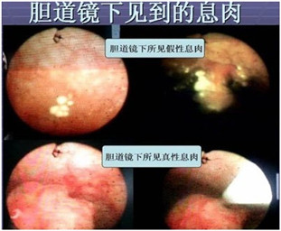 膽囊息肉大危害：癌變幾率高