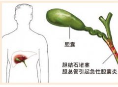 結(jié)石性膽囊炎是怎么回事?