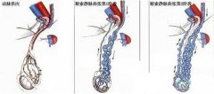 怎么判斷精索靜脈曲張？