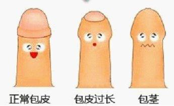 包皮過長