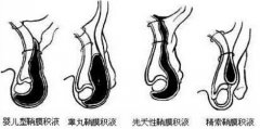 鞘膜積液導(dǎo)致的男性不育如何診斷?