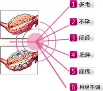 什么是多囊卵巢綜合癥？該如何治療？