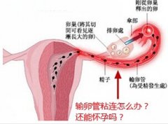輸卵管粘連會(huì)造成什么危害，怎么預(yù)防呢