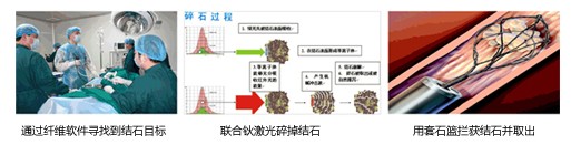 取石步驟