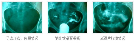 輸卵管造影影像表現(xiàn)