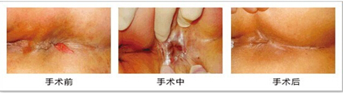 痔瘡治療前后對比.jpg